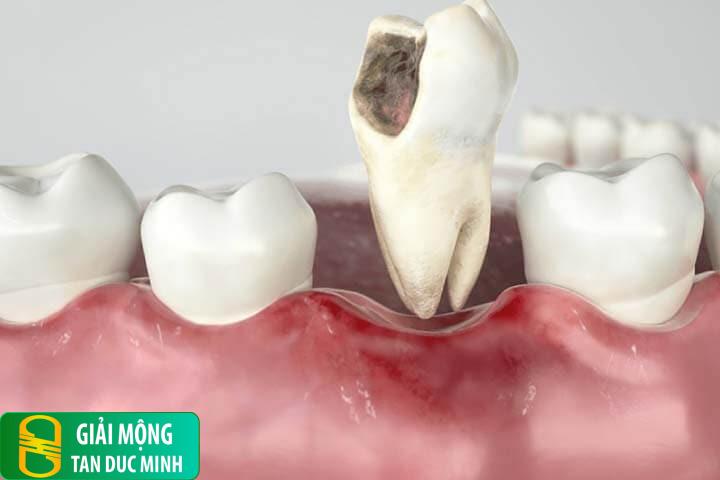 Nằm mơ thấy mình nhổ răng sâu: điềm báo hay chỉ là ám ảnh?